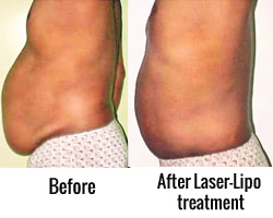 Laser-Lipo-treatment